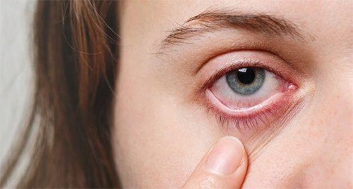 انواع بیماری های چشم، آلرزی چشم