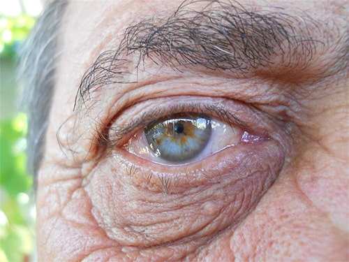 بیماری های چشم، بیماری Macular Degeneration