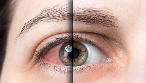 انواع بیماری های چشم، خشکی چشم