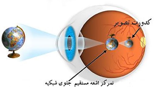 علائم ضعیفی چشم نزدیک بینی