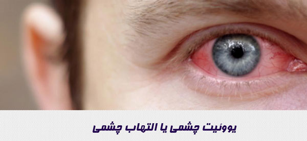 یووئیت چشمی یا التهاب چشمی
